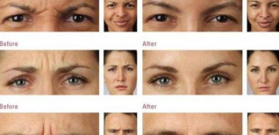 Botox® in South Jersey 
