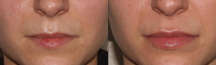 Juvederm® Filler for Lips in South Jersey 