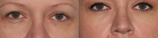 Juvederm® for under eye in South Jersey 