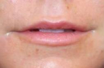 Juvederm<sup>®</sup> for Lips in South Jersey Before