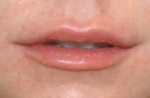 Juvederm<sup>®</sup> for Lips in South Jersey After