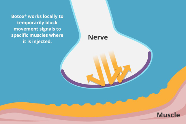 Nerve signals are blocked reducing the muscles ability to contract and cause wrinkles