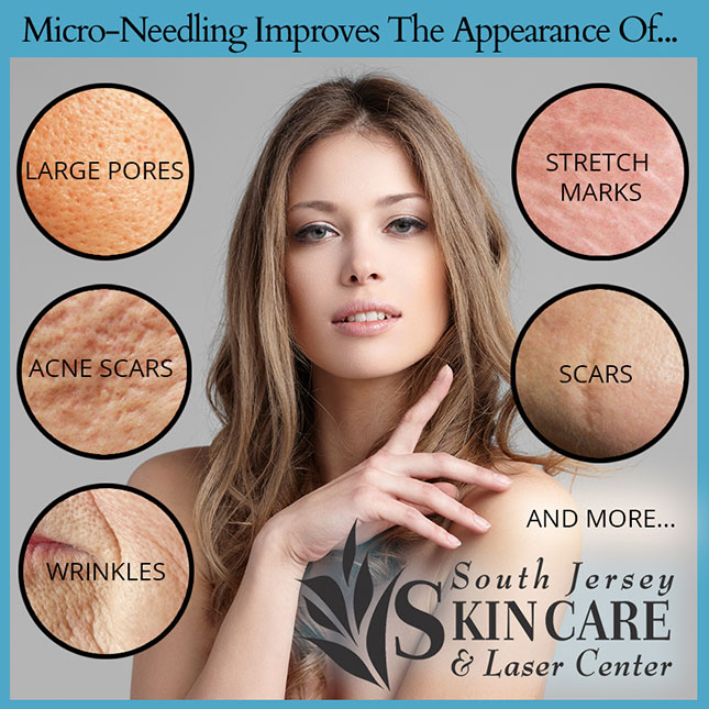 Discover what micro-needling can do at South Jersey Skin Care and Laser Center