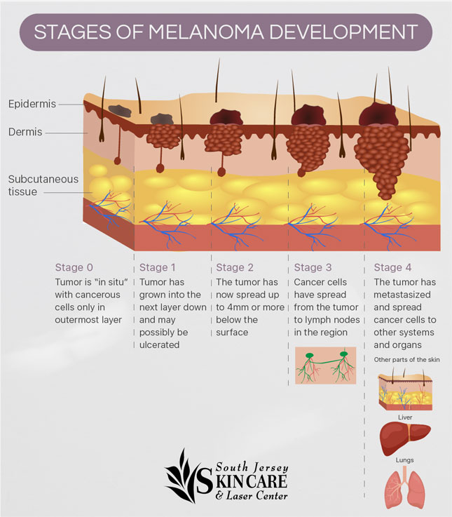 Learn stages 0 through 4 of melanoma, a deadly form of skin cancer, from New Jersey's South Jersey Skin Care.