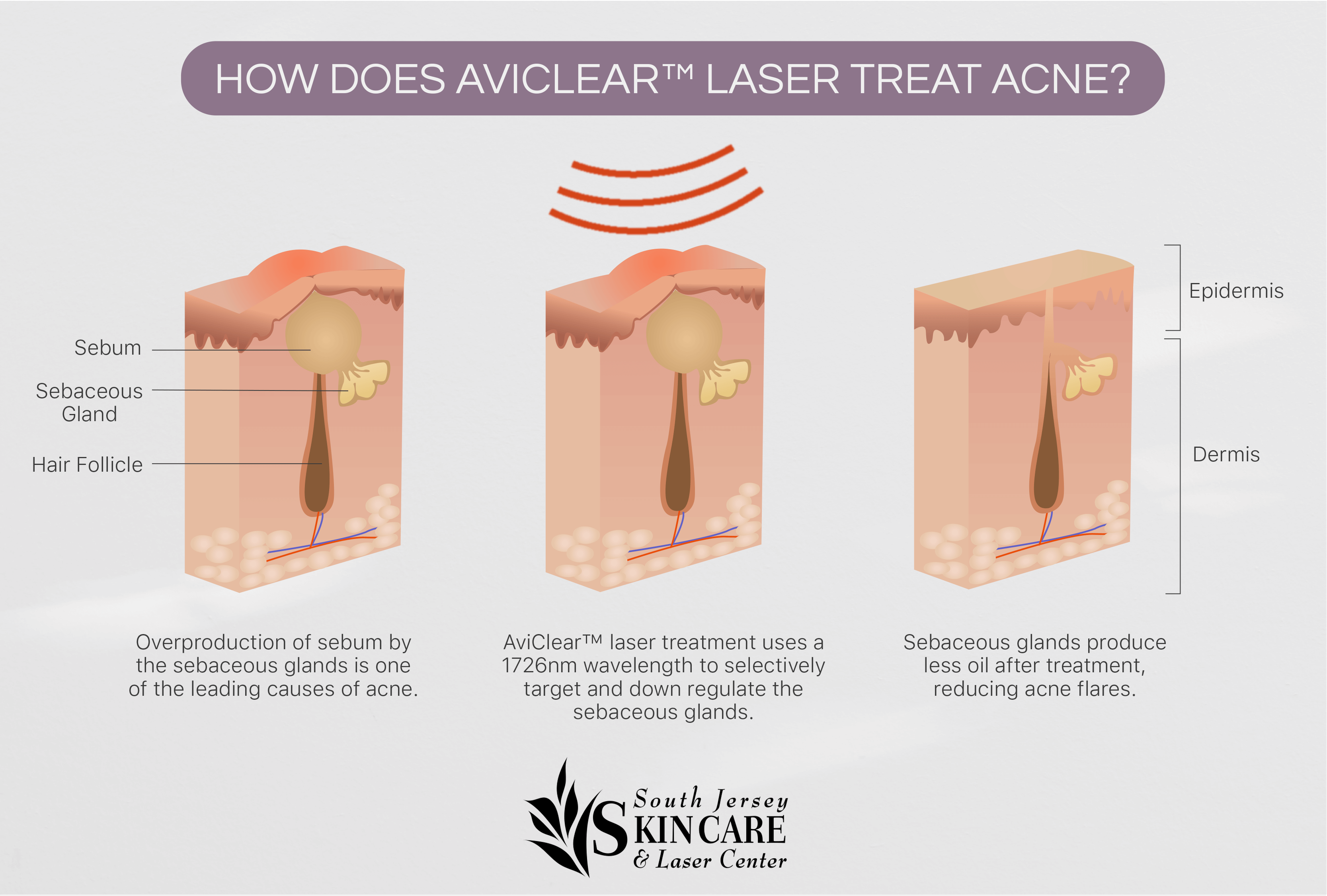 AviClear is a laser-based, oil-reducing acne treatment at South Jersey Skin Care & Laser Center.
