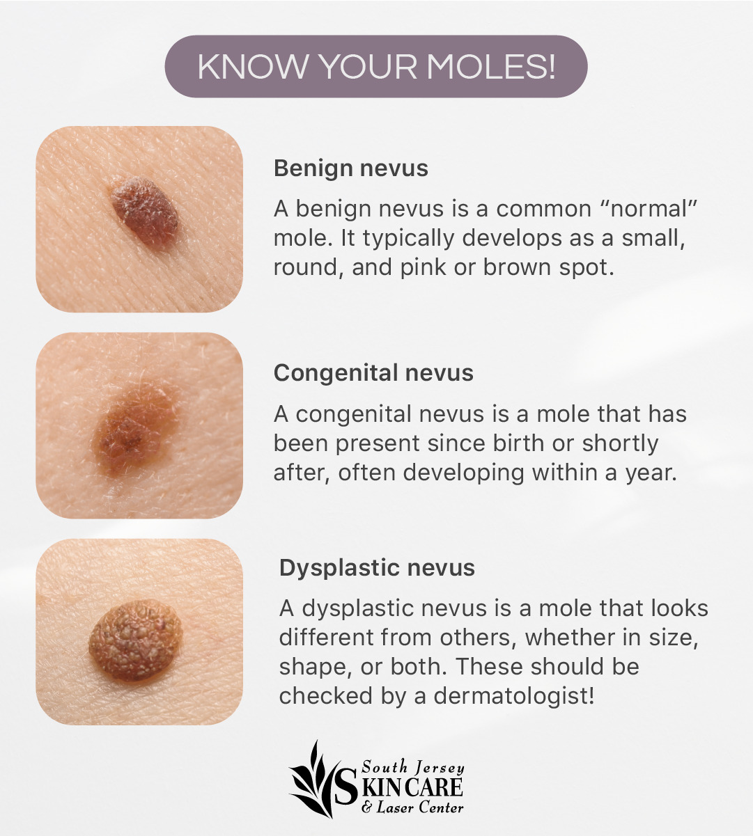 Get info on moles from New Jersey’s South Jersey Skin Care & Laser Center.