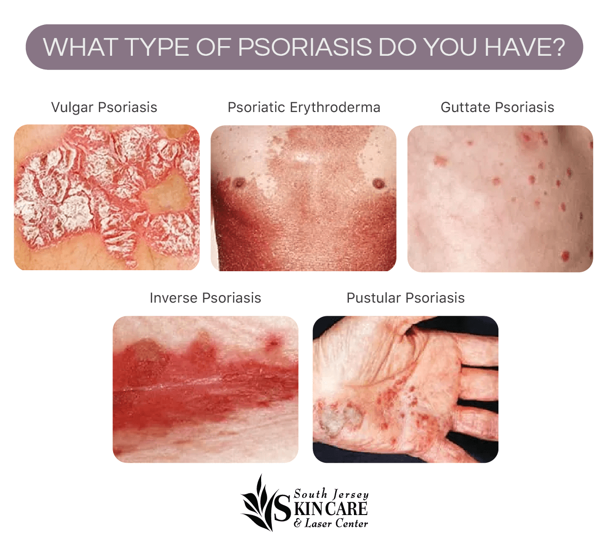 There are many types of psoriasis. NJ’s South Jersey Skin Care & Laser Center explains the various signs and symptoms.